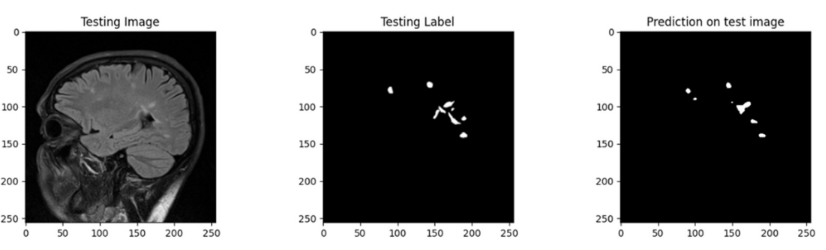 Figure 1: MS Lesion Segmentation Mask.